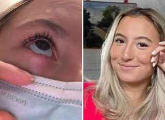 Siri, 22, ei voi itkeä – harvinainen sairaus • Ottaa lääkettä joka kymmenes minuutti news-13082024-020338