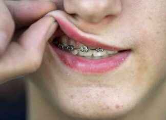 Nuoriin Västerbottenin alueen asukkaisiin kohdistuva tasa-arvoinen hammashoito news-28112024-233507